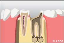 traitement radiculaire