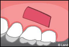 Chirurgie mucogingivale